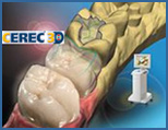 Cerec 3D