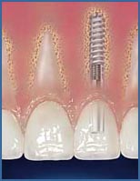 Dental implants